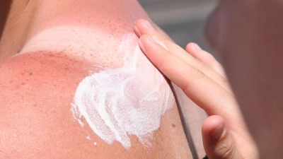 Zu viel Sonne auf die Schultern bekommen? Dann helfen Kühlung und eine beruhigende Hautpflege. (Foto: Stephanie Pilick/dpa/dpa-tmn)
