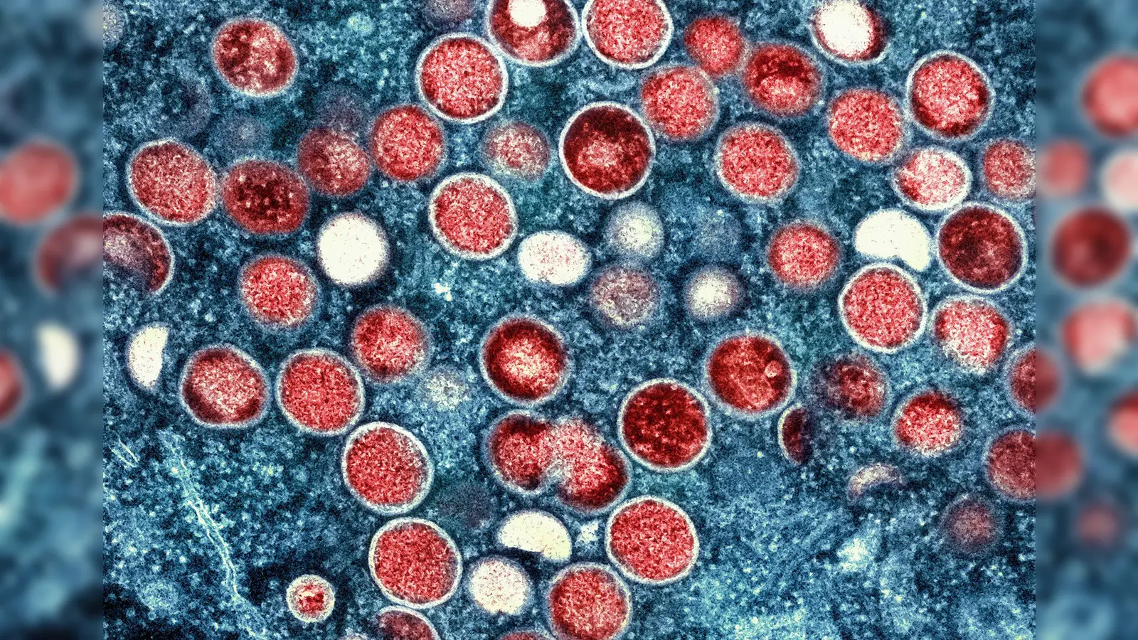 Die WHO ist besorgt über die mögliche Ausbreitung einer neuen Mpox-Sublinie  (Foto: National Institute of Allergy and Infectious Diseases/AP/dpa)