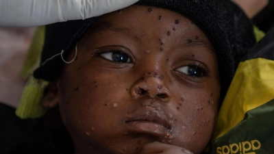 Neue Tests sollen die Ausbreitung von Mpox eindämmen helfen. (Archivbild) (Foto: Moses Sawasawa/AP/dpa)